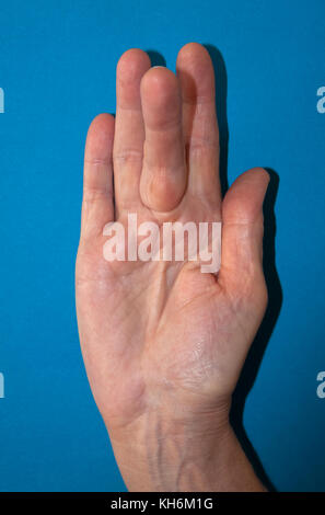 Dupuytren Kontraktur der Deformität: eine Schnur in der Hand (mit einem harten Knötchen an der Basis des Mittelfingers) zieht den Finger in eine verbogene Position. Stockfoto