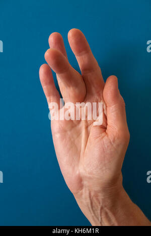 Dupuytren Kontraktur der Deformität: eine Schnur in der Hand (mit einem harten Knötchen an der Basis des Mittelfingers) zieht den Finger in eine verbogene Position. Stockfoto