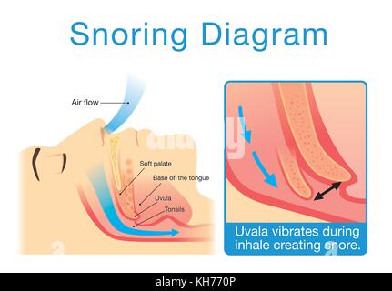 Anatomie der menschlichen der oberen Atemwege während des Schlafes mit Schnarchen. Stock Vektor