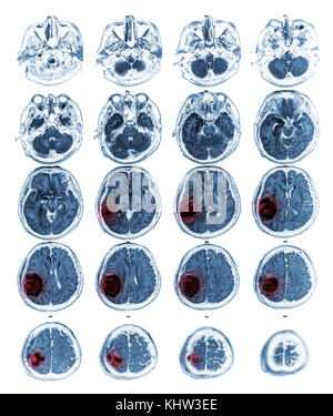 Mri Gehirn Brain Tumor an der rechten parietalen Lappen. Stockfoto