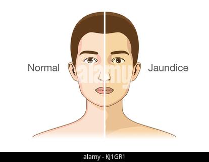Der Vergleich zwischen der normalen Haut die Leute Stock Vektor
