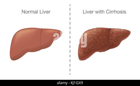 Der Vergleich zwischen gesunde Leber und Zirrhose. Stock Vektor