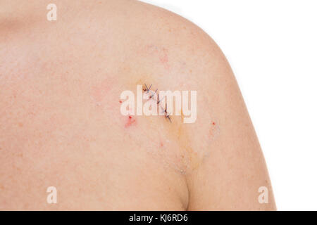 Muttermal oder entformung Konzept mit Stichen oder Zeichenfolgen auf Frau Schulter Stockfoto