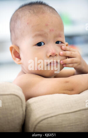 Asiatische Babysitting auf Couch mit Windpocken Ausschlag, natürliche Fotos. Stockfoto