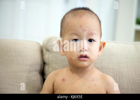 Asiatische 20 Monate altes Baby sitzen auf der Couch mit roten Flecken von Windpocken, natürliche Fotos. Stockfoto