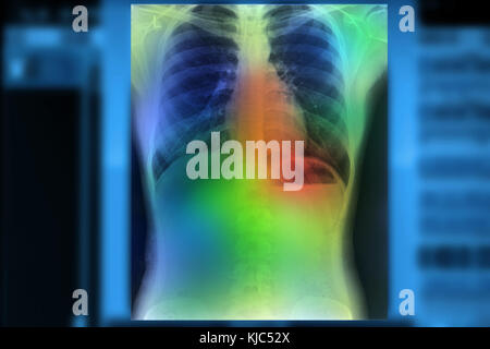 Künstliche Intelligenz in smart Healthcare Hospital Technologie Konzept. AI-Algorithmus und maschinelles Lernen erkennen, Pneumonie und Krebszelle in X-Rays Stockfoto