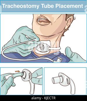 Vector Illustration einer Trachealkanüle Platzierung Stock Vektor