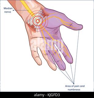 Quer carpal Ligament komprimiert mittlere Nerv hand Stock Vektor