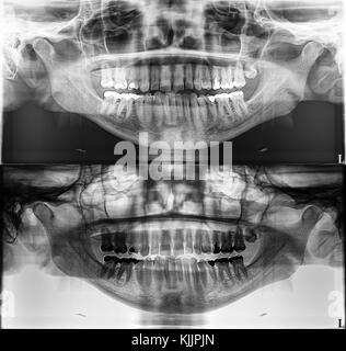 Panoramablick dental Xray, feste Zähne, Dental amalgam Dichtung, Weisheitszahn seitlich, horizontal belastet Stockfoto