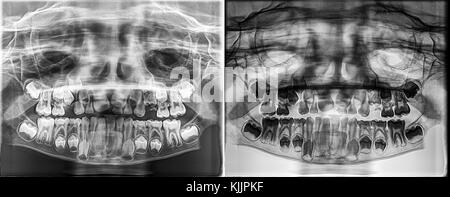 Panoramablick dental Xray eines Kindes, laubbäume - Milch Zähne wachsen aus den Kieferknochen Stockfoto