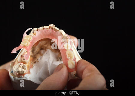 Eine Prothese auf einem Gips Basis in der Hand eines Zahnarztes. close-up auf schwarzem Hintergrund Stockfoto