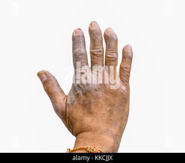 Nahaufnahme der Psoriasis an den Händen der Landwirte auf weißem Hintergrund, Dermatologie Haut Krankheit. Psoriasis finger Deformität. Stockfoto