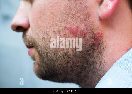 Hautausschlag Reaktion von Droge oder Nahrungsmittelallergie auf das Gesicht der kaukasischen Mann Stockfoto