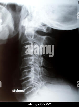 Menschliche Hals sidelong in x-ray Stockfoto
