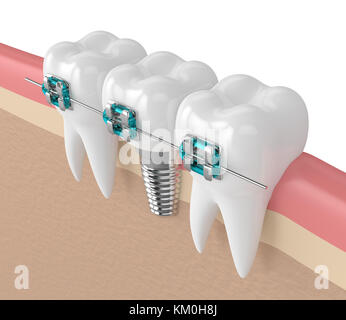 3D-Render von Zähnen bei Zahnimplantat und Klammern in Zahnfleisch Stockfoto