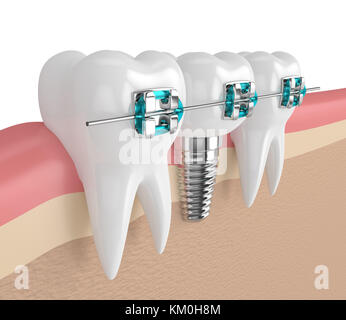 3D-Render von Zähnen bei Zahnimplantat und Klammern in Zahnfleisch Stockfoto