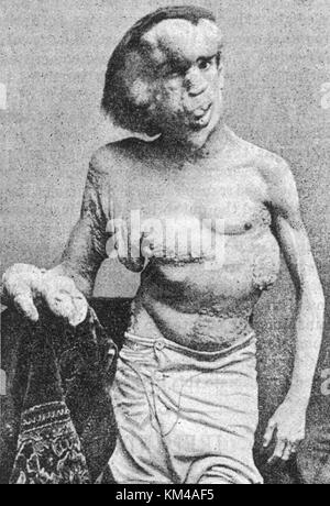 Joseph carey Merrick, englisch Mann mit sehr schweren Missbildungen wie der "Elephant Man" bekannt, Stockfoto