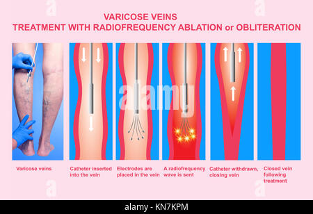 Krampfadern und Behandlung mit radiofrequenzablation Stockfoto