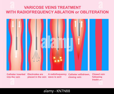 Krampfadern und Behandlung mit radiofrequenzablation Stockfoto