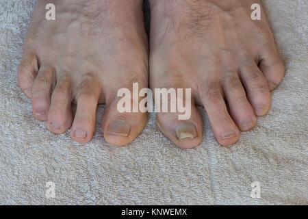 Trauma Verletzung durch dicht schließende Sport Schuhe die Nagelplatte abheben Bett und Öffnung Bereich Pilzinfektion Onychomykose zu zehennagel Stockfoto