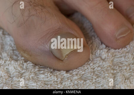 Trauma Verletzung durch dicht schließende Sport Schuhe die Nagelplatte abheben Bett und Öffnung Bereich Pilzinfektion Onychomykose zu zehennagel Stockfoto
