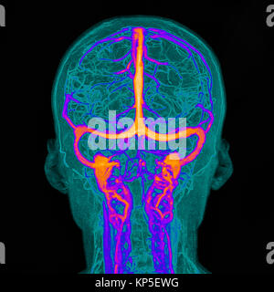 Intrakraniellen Blutgefäße, Abbildung auf einem farbigen Magnetresonanztomographie (MRT) Scan eines menschlichen Gehirn und seinen Intrakraniellen Blutgefäße basierend Stockfoto