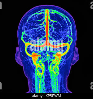 Intrakraniellen Blutgefäße, Abbildung auf einem farbigen Magnetresonanztomographie (MRT) Scan eines menschlichen Gehirn und seinen Intrakraniellen Blutgefäße basierend Stockfoto