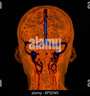 Intrakraniellen Blutgefäße, Abbildung auf einem farbigen Magnetresonanztomographie (MRT) Scan eines menschlichen Gehirn und seinen Intrakraniellen Blutgefäße basierend Stockfoto