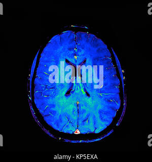 Farbige Magnetresonanztomographie (MRT) Scan eines Sagittalschnitt durch eines Patienten Kopf, eines gesunden menschlichen Gehirns. Stockfoto