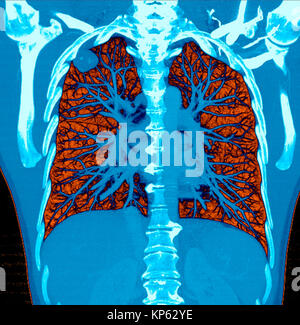 Farbige CTscan der oberen Brust einen Tumor in der Lunge. Stockfoto