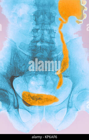 NIEREN-KOLIK, X-RAY Stockfoto