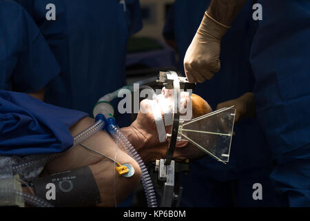 Die tiefe Hirnstimulation Stockfoto