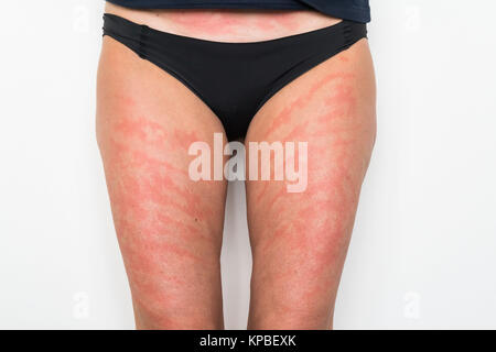 Allergische Kontaktdermatitis Farbstoffe in Textilien enthalten. Stockfoto