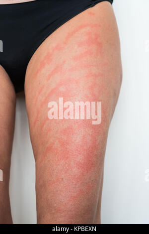 Allergische Kontaktdermatitis Farbstoffe in Textilien enthalten. Stockfoto