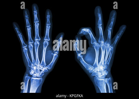 X-ray beide Hände mit OK Sign. Stockfoto