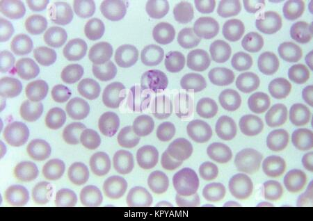 Blutausstrich mit Babesia sp, 1973. Ringe mit basophilen Tamponieren innerhalb der Erythrozyten. Plasmodium falciparum Babesia Organismen ähneln, jedoch Parasiten Babesia mehrere Unterscheidungsmerkmale. Sie variieren in Form und Größe, und Sie haben keine Pigmente produzieren. Bild mit freundlicher Genehmigung von CDC/Dr. Mae Melvin. Stockfoto