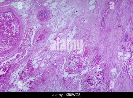 Dieses Bild zeigt die histopathologic Änderungen mit zygomycosis des Magens, 1965 verbunden. Die Infektion, die Mitglieder der Klasse Zygomycetes, umfasst in der Regel die Rhino - Gesichtsbehandlung - kraniale Fläche, Lunge, Magen-Darm-Trakt und die Haut. Diese Krankheit tritt häufig bei immunsupprimierten Patienten, oder brennen, oder solche, die auf steroid Therapie. Bild mit freundlicher Genehmigung von CDC/Dr. Martin Hicklin. Stockfoto