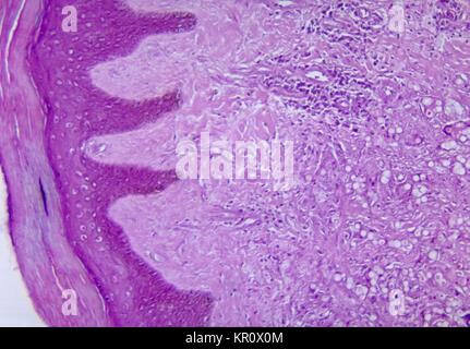 Dieses Bild zeigt die Änderungen mit histopathologic lobomycosis der Haut, 1965. Diese chronische Pilzinfektionen ist durch den Pilz Lacazia loboi verursacht, früher unter dem Namen Loboa loboi und wird von Keloidal noduläre Läsionen auf dem Gesicht, Ohren, oder der Extremitäten aus. Diese Krankheit ist in der Regel in den Menschen und in der Flasche - gerochen Delphine gefunden. Bild mit freundlicher Genehmigung von CDC/Dr. Martin Hicklin. Stockfoto