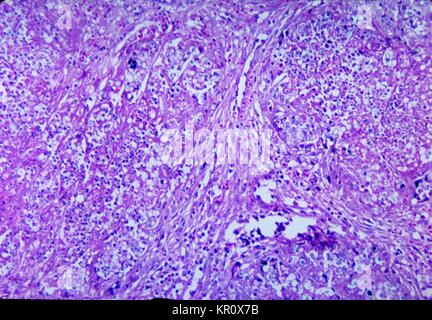 Dieses Bild zeigt die histopathologic Änderungen der Milz durch Histoplasma duboisii, 1965. Histoplasmose, durch Histoplasma Duboisii, ist ein antimykotischen Infektion vor allem mit Haut-, Leber-, Lungen-, Lymph, subkutane und knöchernen Geweben. Bild mit freundlicher Genehmigung von CDC/Dr. Martin Hicklin. Stockfoto