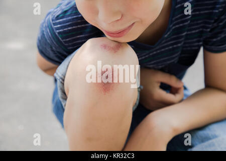 Nahaufnahme des verletzten Jungen kid Knie, nachdem er fiel auf Pflaster Stockfoto