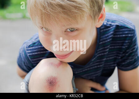 Nahaufnahme des verletzten Jungen kid Knie, nachdem er sich auf Pflaster fiel. Funny cute Boy stellt für Kamera mit echten Verwundeten abgekratzt Bein. Stockfoto