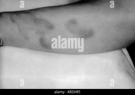 Ein Foto von einem Patienten mit tertiäre Syphilis Darstellung ureas gummatous Läsionen auf der Oberfläche der rechten Arm. Tertiäre Syphilis tritt auf, viele Jahre nach der unbehandelten primären Syphilis, 1971. Gummas oder innere Gewebe Granulation, Form und zu schweren Schäden an der Haut, Knochen, Leber und andere körperliche Organe, oder Regionen. Mit freundlicher CDC/Susan Lindsley. Stockfoto