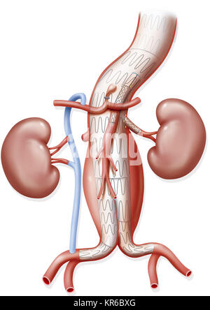 ANEURYSMA BEHANDLUNG Stockfoto