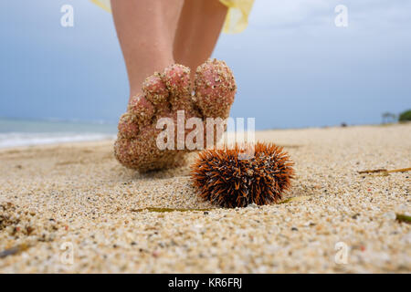 Ein Mann geht am Strand entlang und ist etwa auf ein giftiger Seeigel zu treten. Gefahr in den Ferien in einem tropischen Land. Stockfoto
