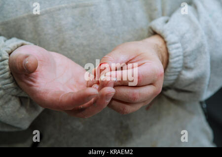 Nahaufnahme der Wunde und trockenen Blut am Bein. Wunde im Blut Stockfoto