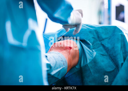 Kniechirurgie, orthopädischen Operation - Chirurgen durchführen einer Kniechirurgie auf einen Patienten (flacher DOF Farbe getonte Bild) Stockfoto