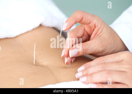 Arzt mit Akupunktur auf Abdomen des Patienten Stockfoto
