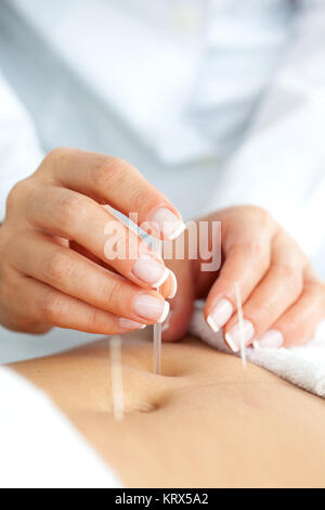 Arzt mit Akupunktur auf Abdomen des Patienten Stockfoto