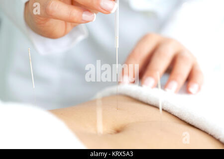Arzt mit Akupunktur auf Abdomen des Patienten Stockfoto