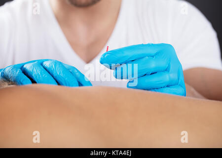 Physiotherapeut tun Akupunktur auf der Rückseite Stockfoto